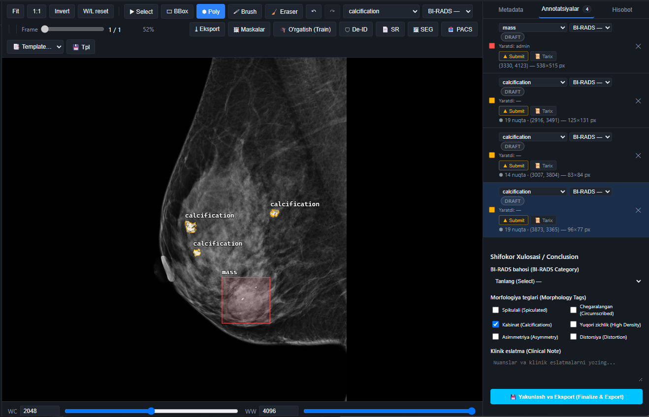 Breast Cancer Mammogram Scan